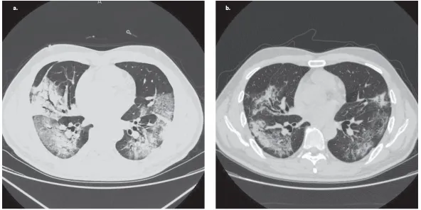 Bevacizumab treatment beneficial for patients with severe COVID-19